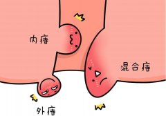 痔疮外痔有个肉球怎么消除？